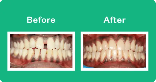 invisalign before and after