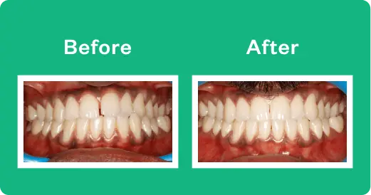 invisalign near me