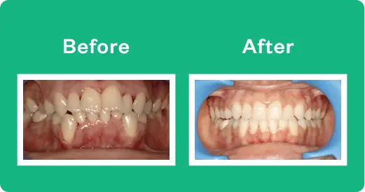 invisalign braces