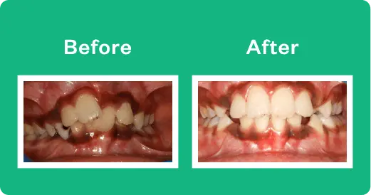 invisalign prices in india