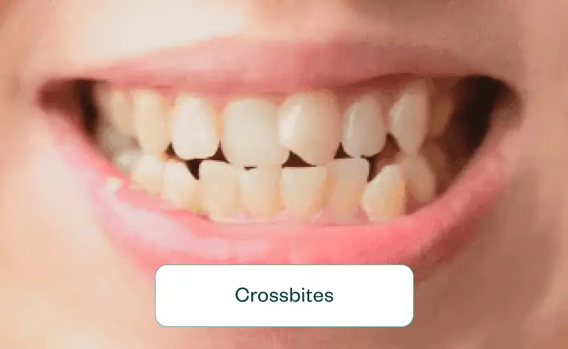 invisalign vs braces