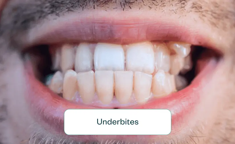 invisalign prices in india