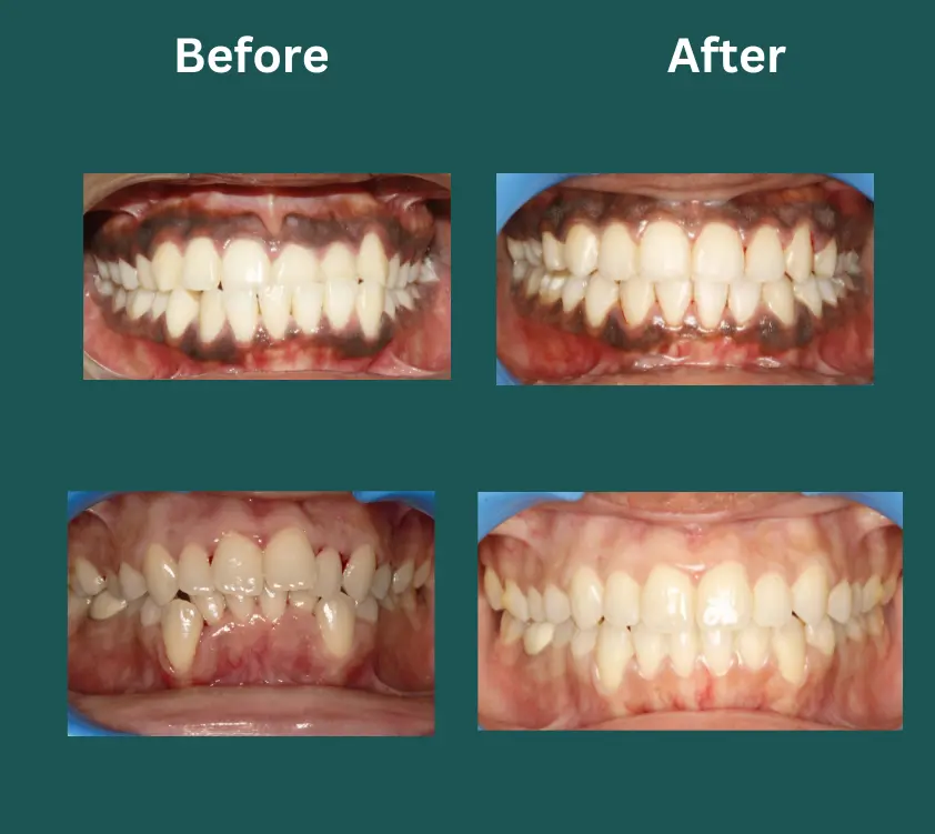 invisalign near me