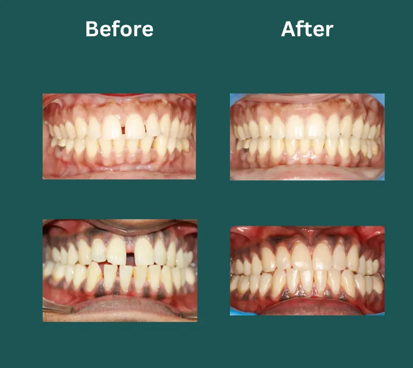 invisalign near me