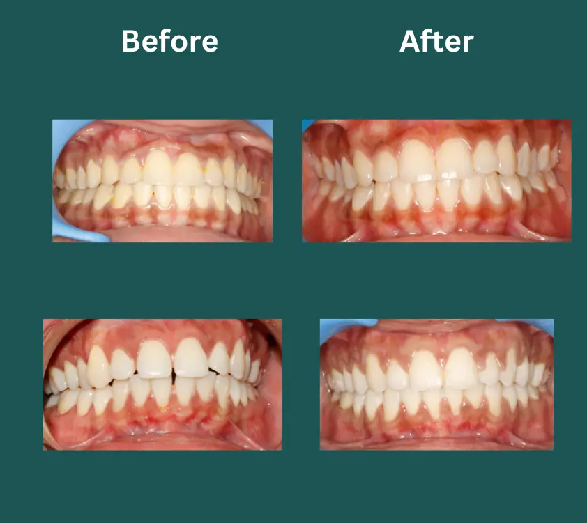 invisalign near me