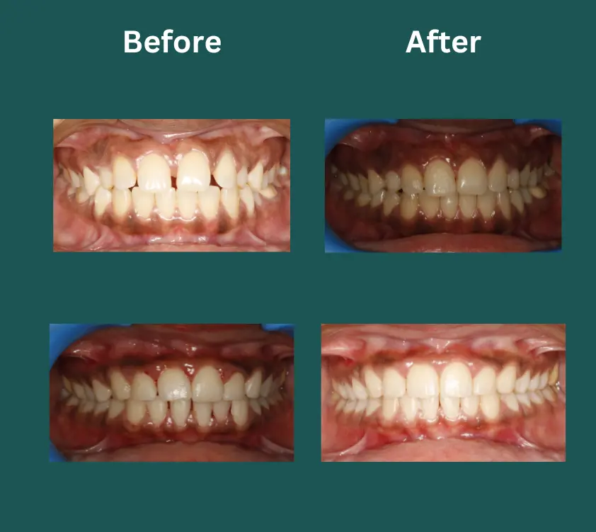 invisalign near me