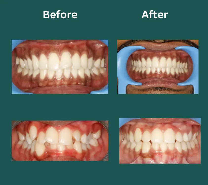 invisalign near me