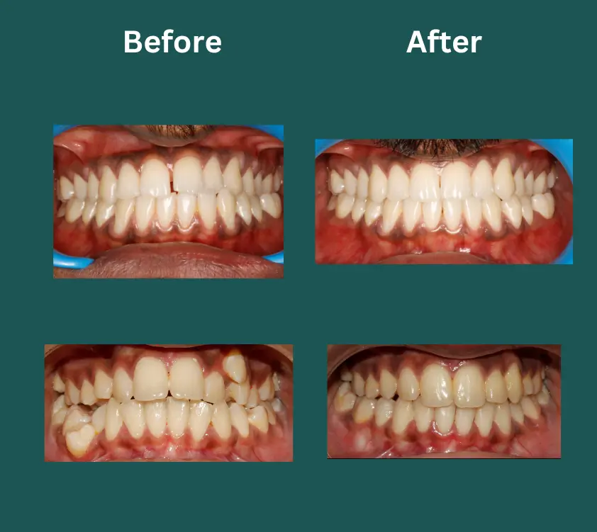 invisalign near me