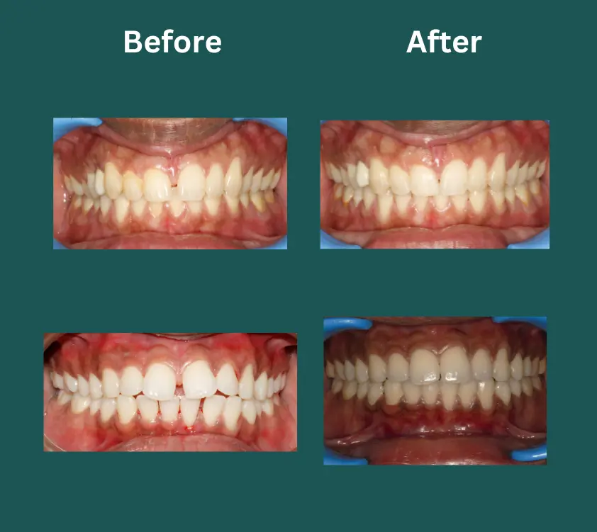 invisalign near me