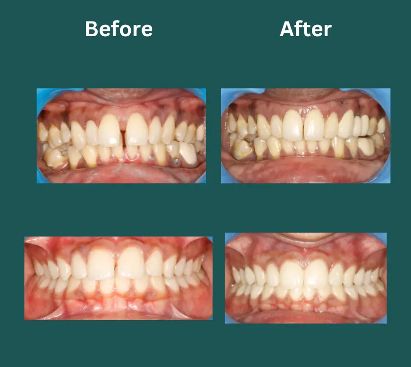 invisalign near me