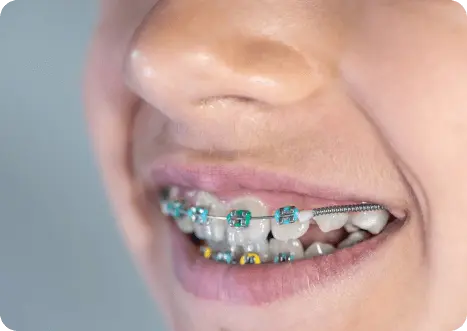 invisalign prices in india