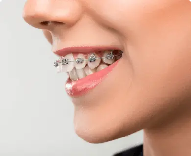 invisalign vs braces